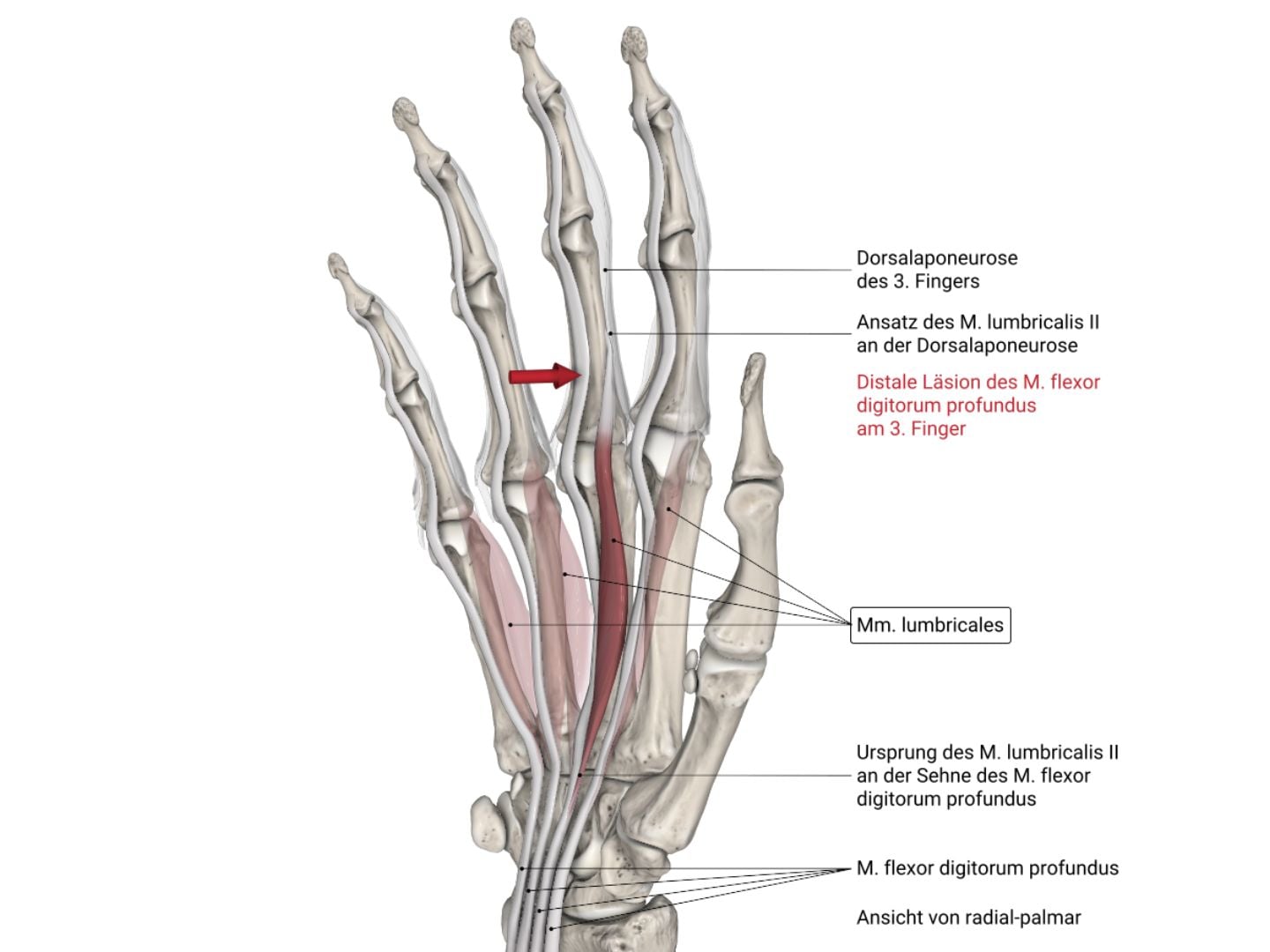 Paradoxe Extension (Lumbricalis-Plus-Syndrom)