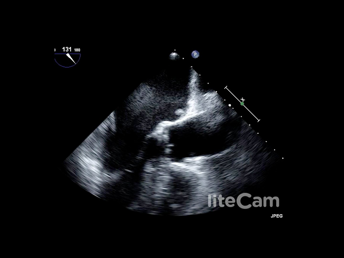 Mobiler Thrombus im linken Vorhof