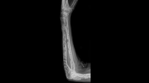 Multiple Osteolysen am Unterarm