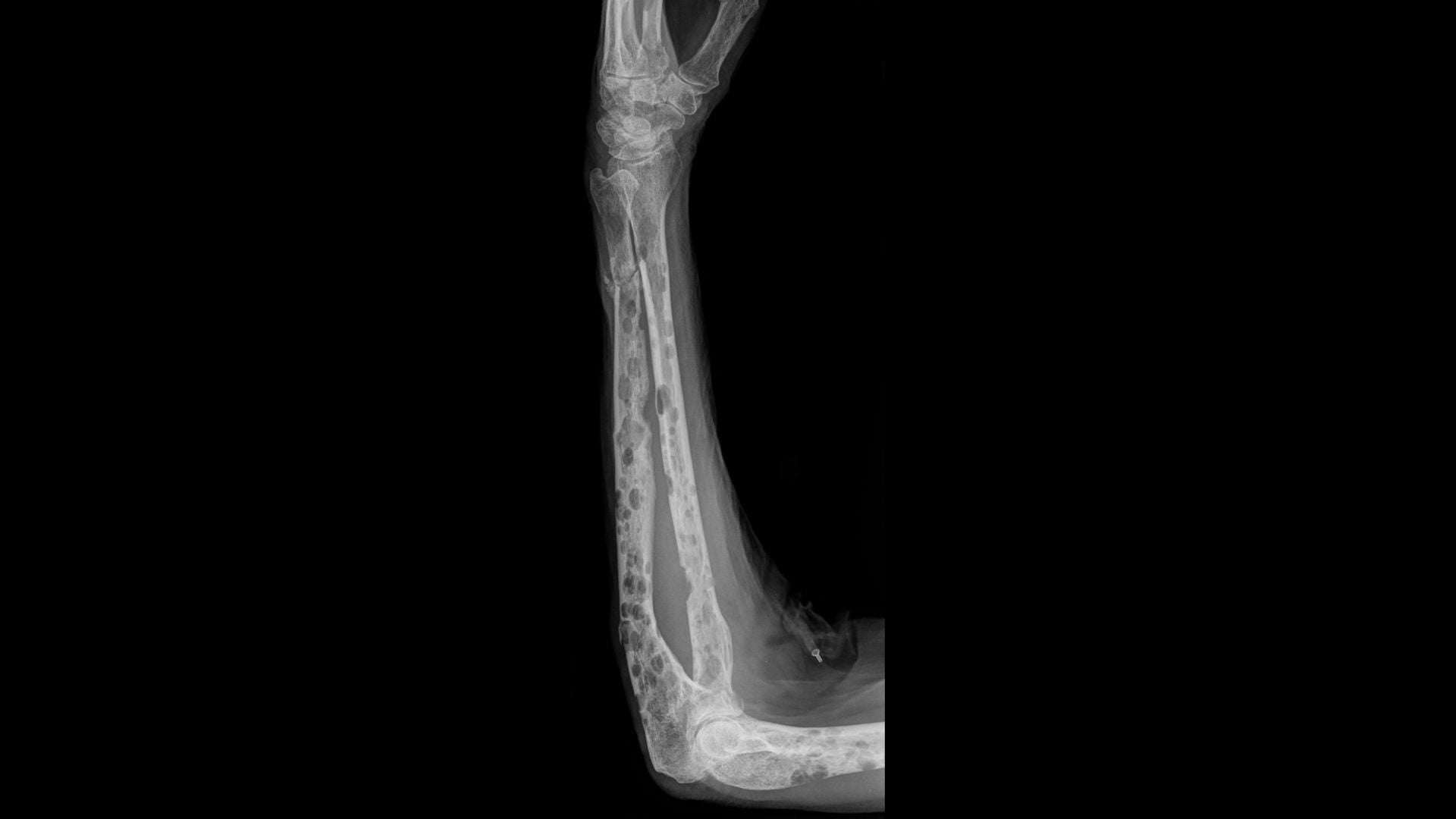 Multiple Osteolysen am Unterarm