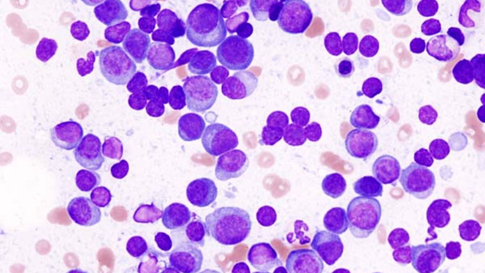 Multiples Myelom Blutausstrich nach Pappenheim