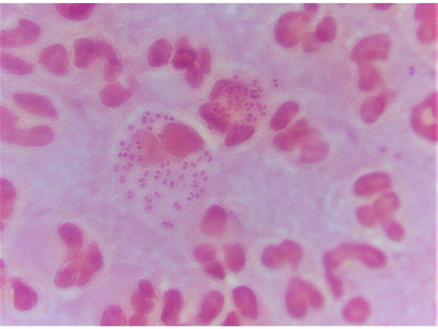 Mikroskopischer Befund von Neisseria gonorrhoeae 