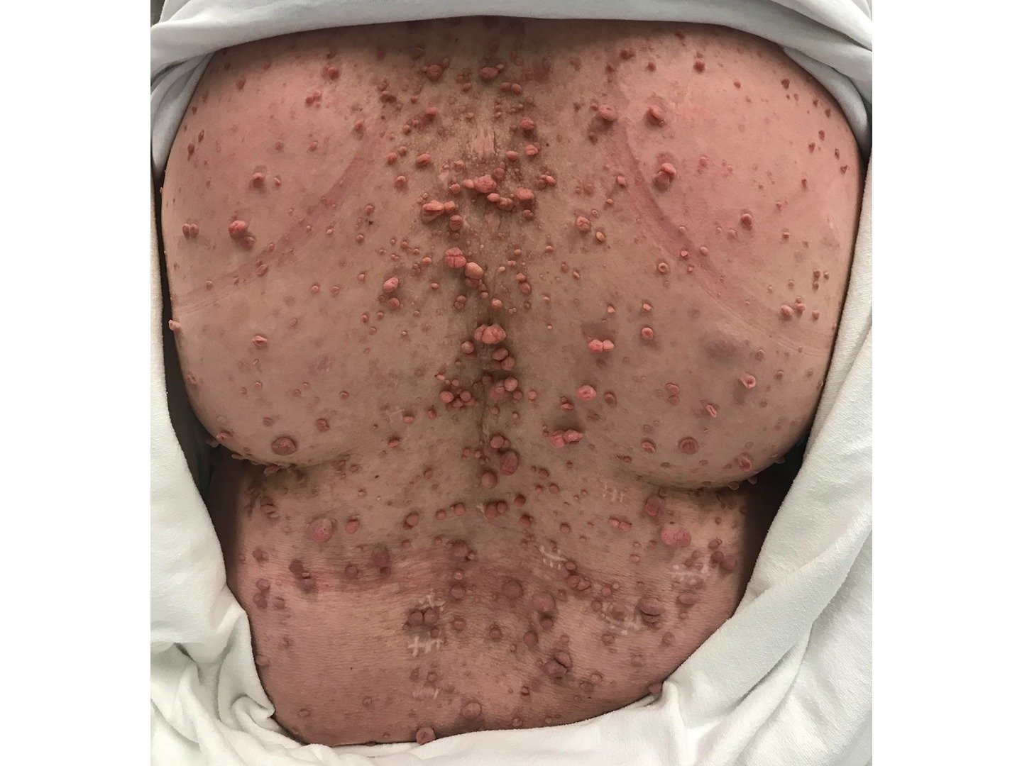 Neurofibrome