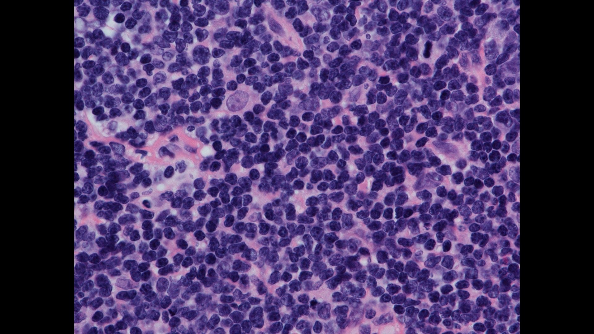 Noduläres Mantelzell-Lymphom