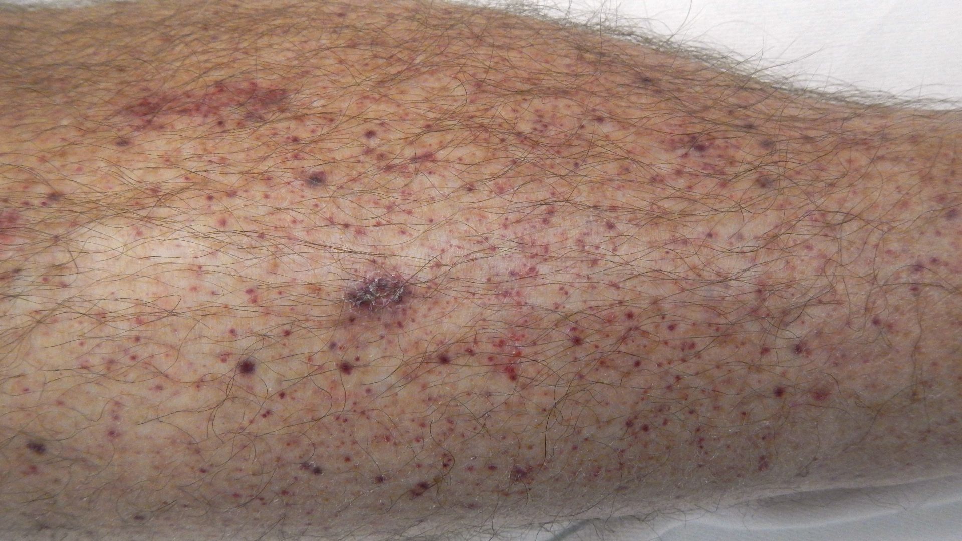 Petechien bei Sepsis
