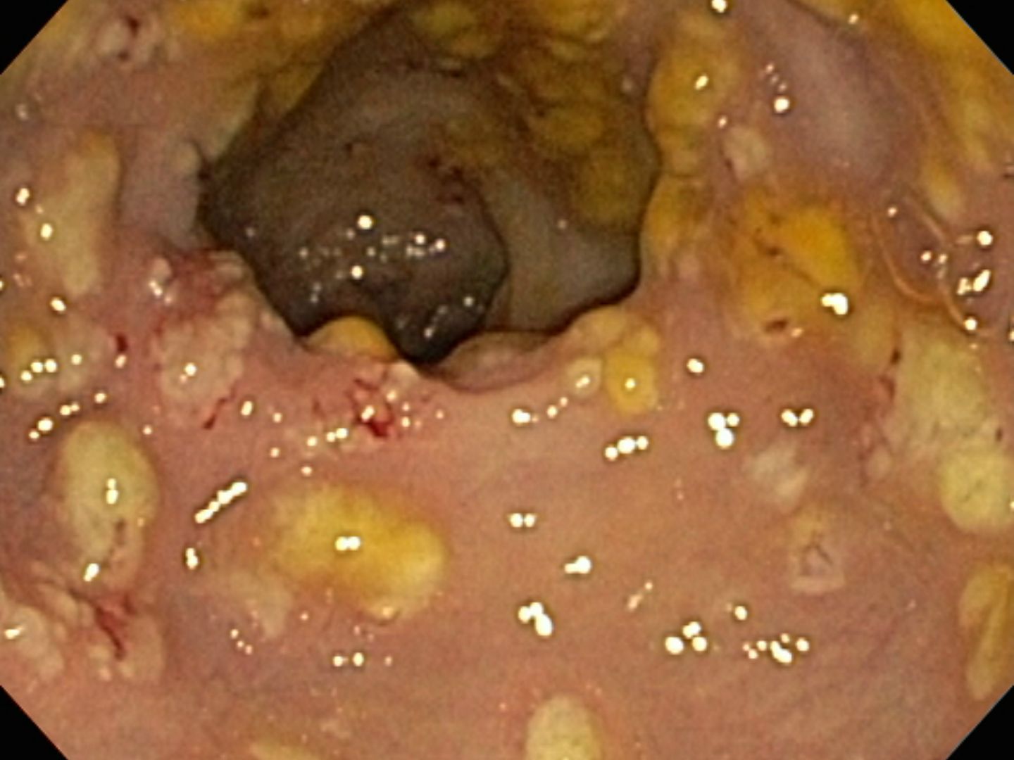 Pseudomembranöse Kolitis