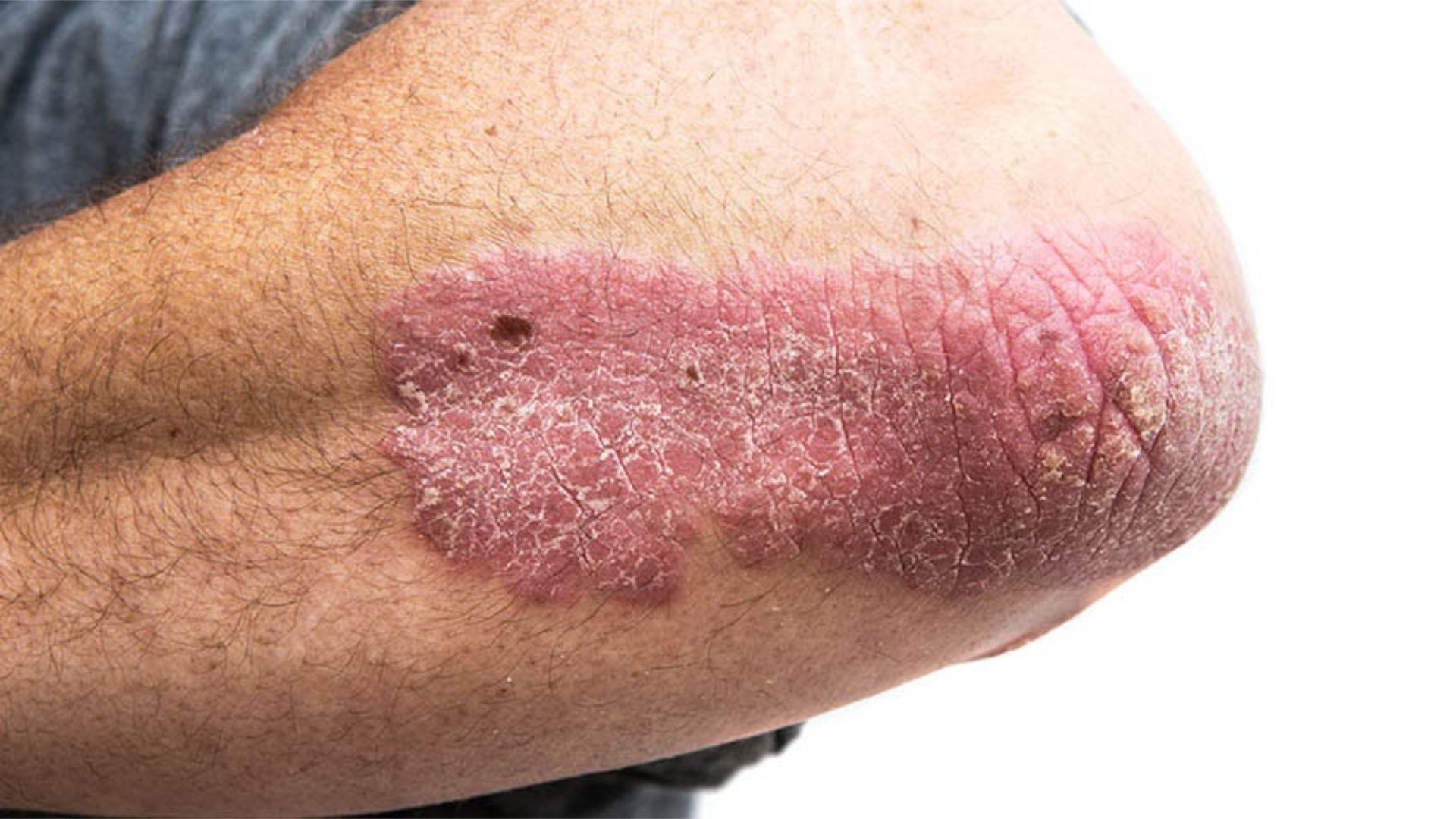 Psoriasis vulgaris am Ellenbogen