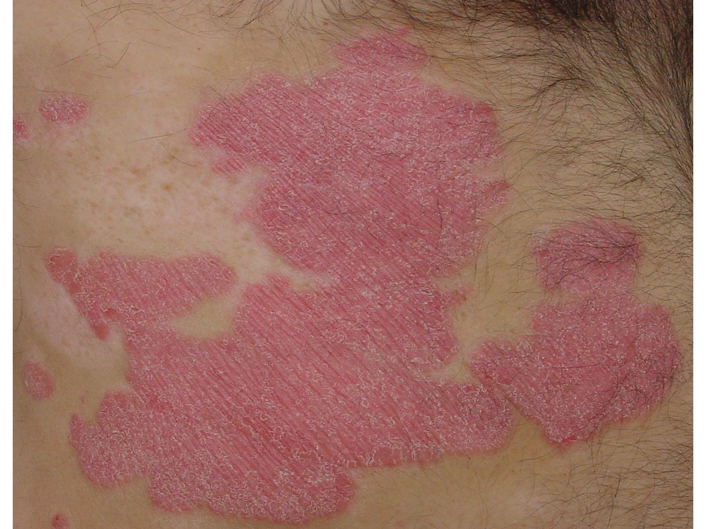 Psoriasis-Plaque