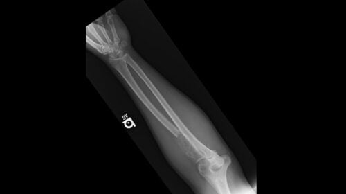 Radius Läsionen