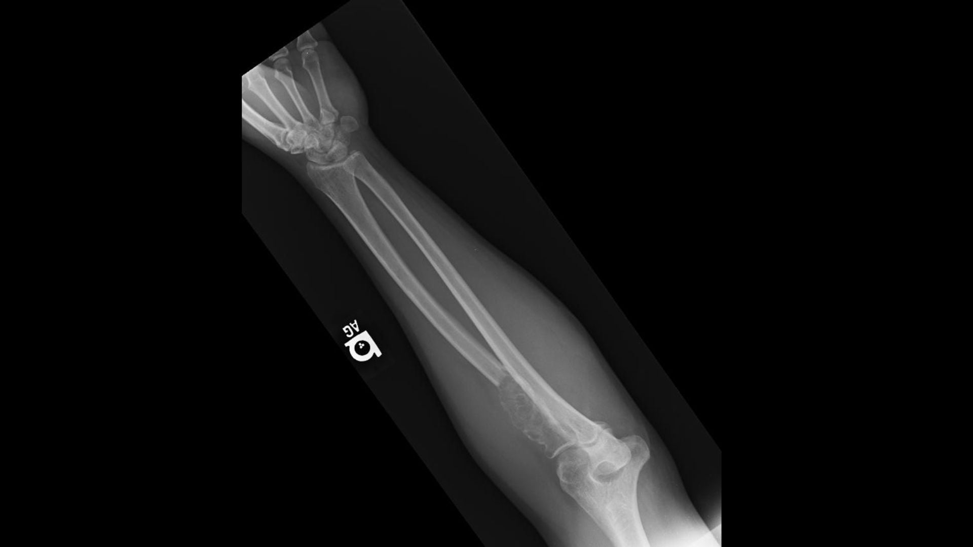 Radius Läsionen