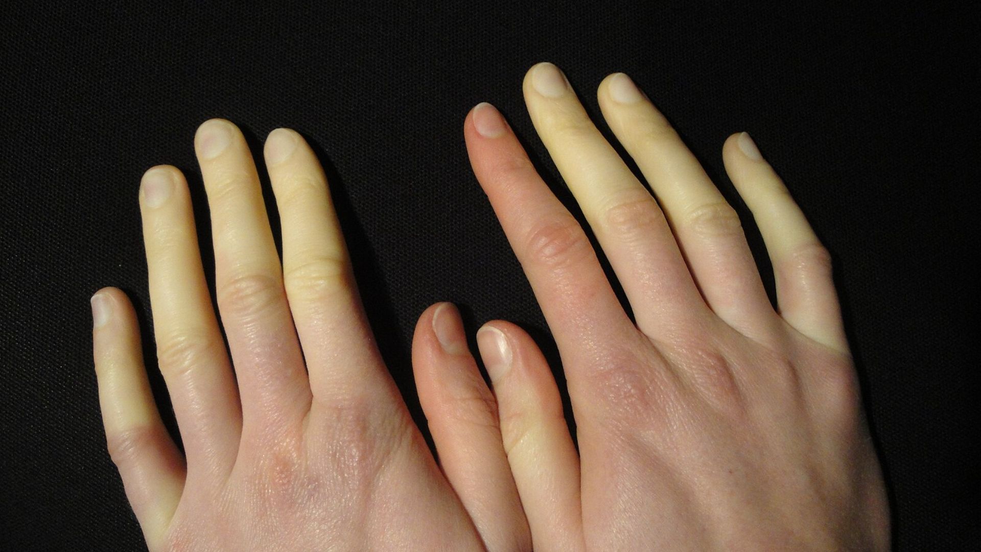 Raynaud-Syndrom 