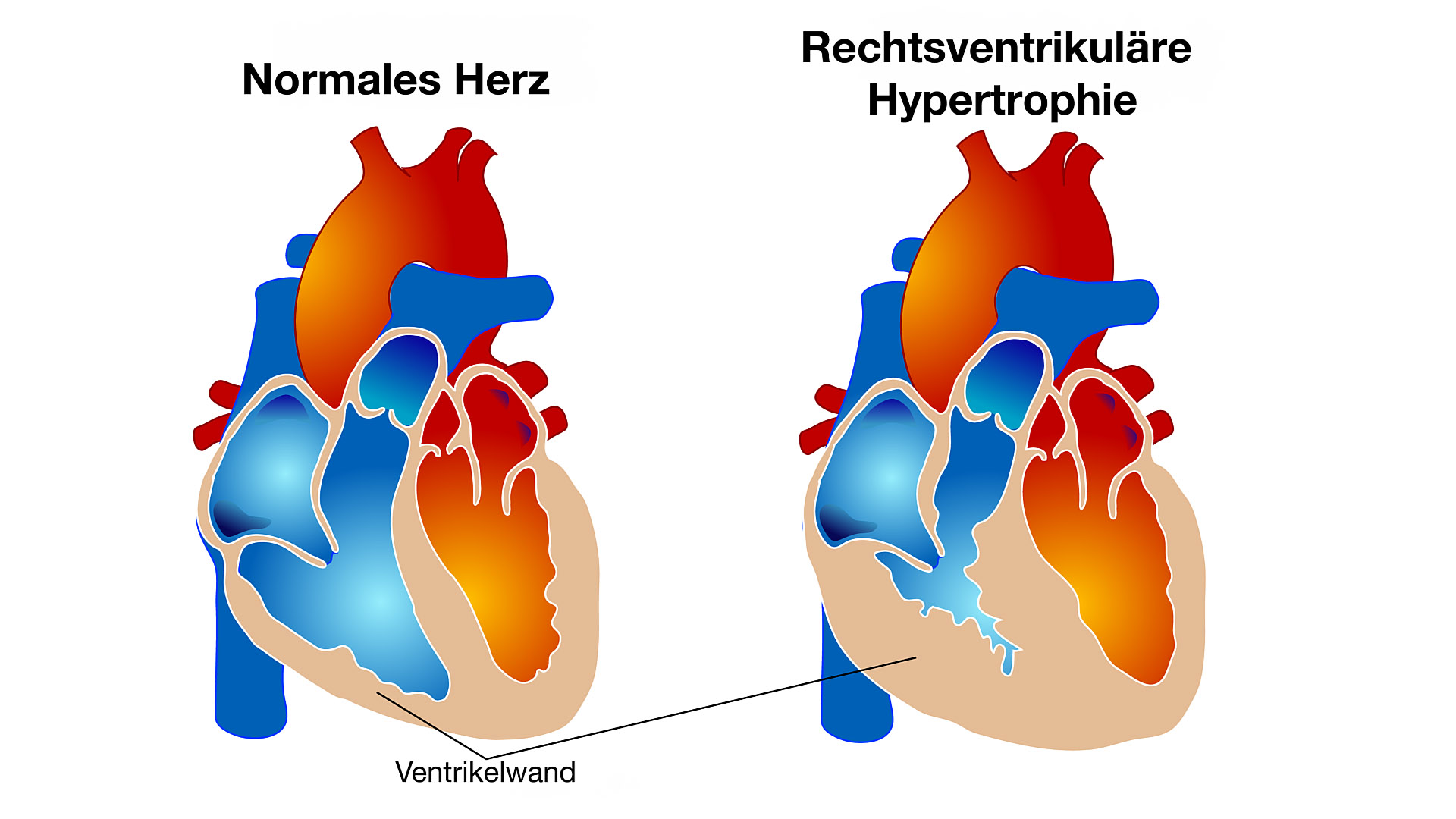 Eingeschränkte rechte Ventrikelfüllung bei Hypertrophie