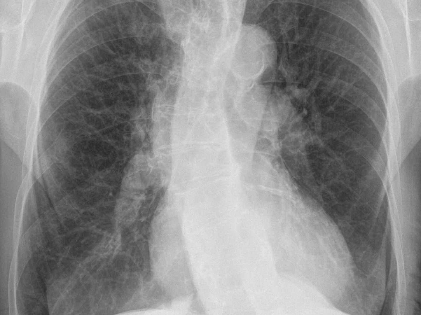 Rö-Thx: COPD und CTEPH