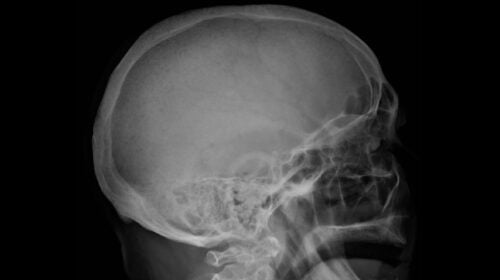 Schädelröntgen bei Multiplem Myelom