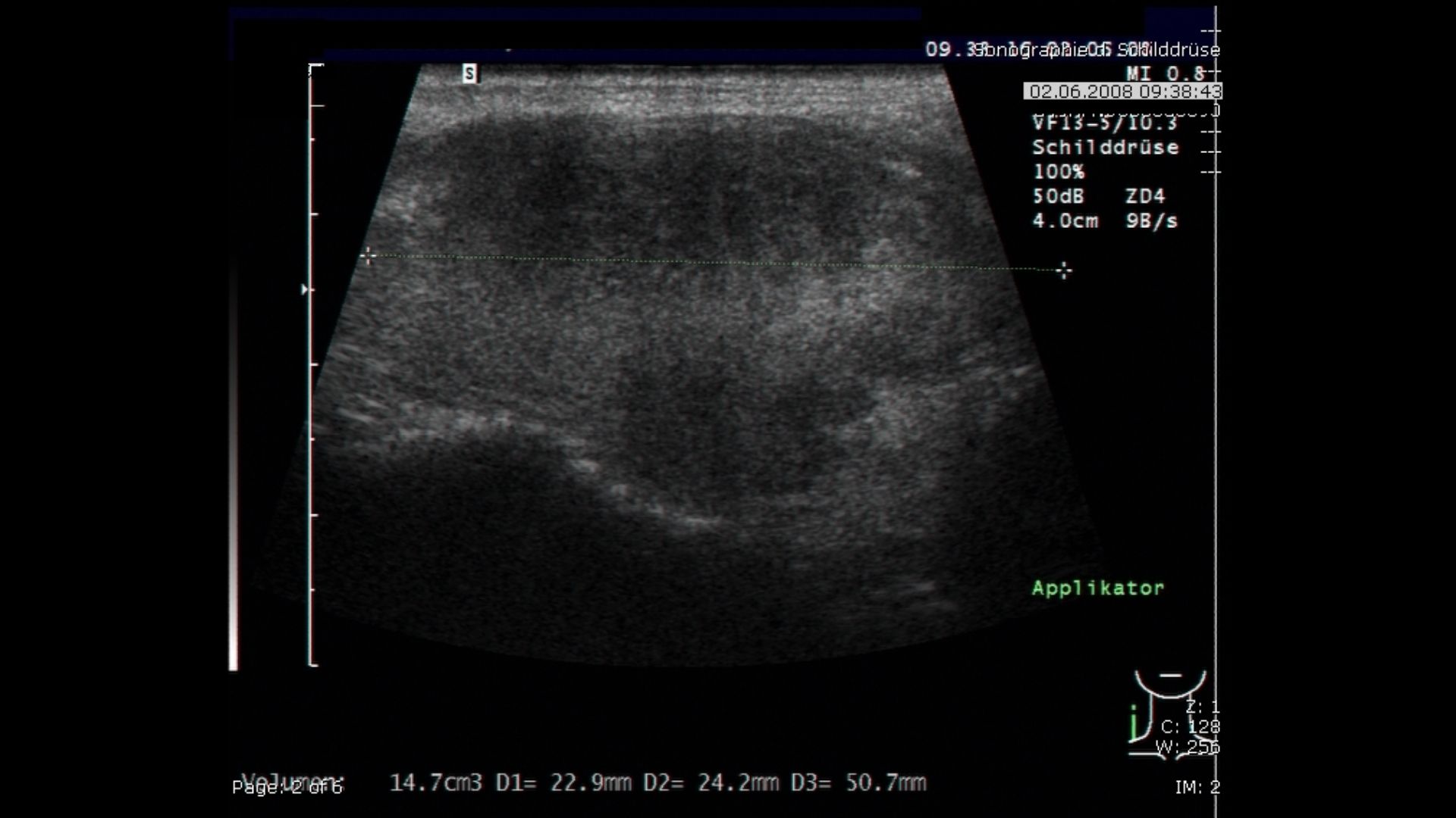 Sonographie Thyreoiditis
