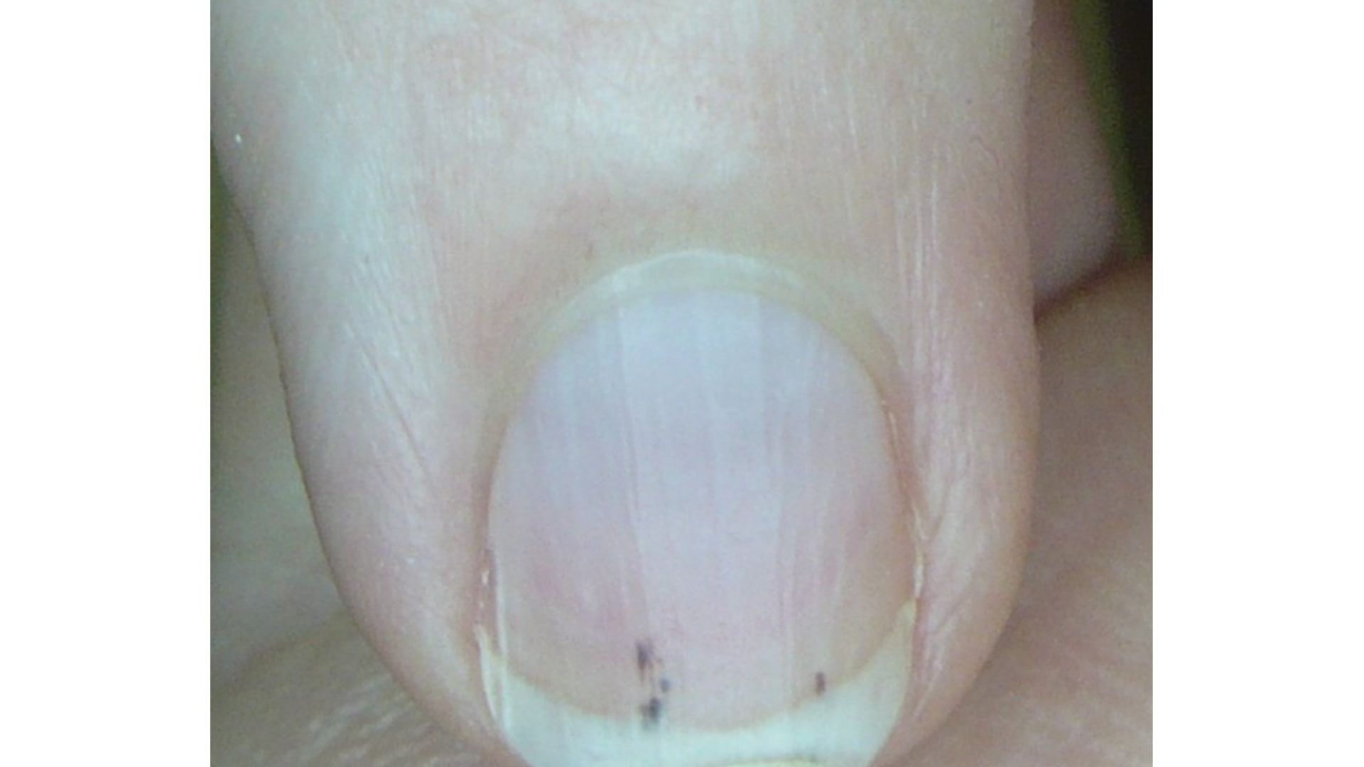 Splinter Hämorrhagien