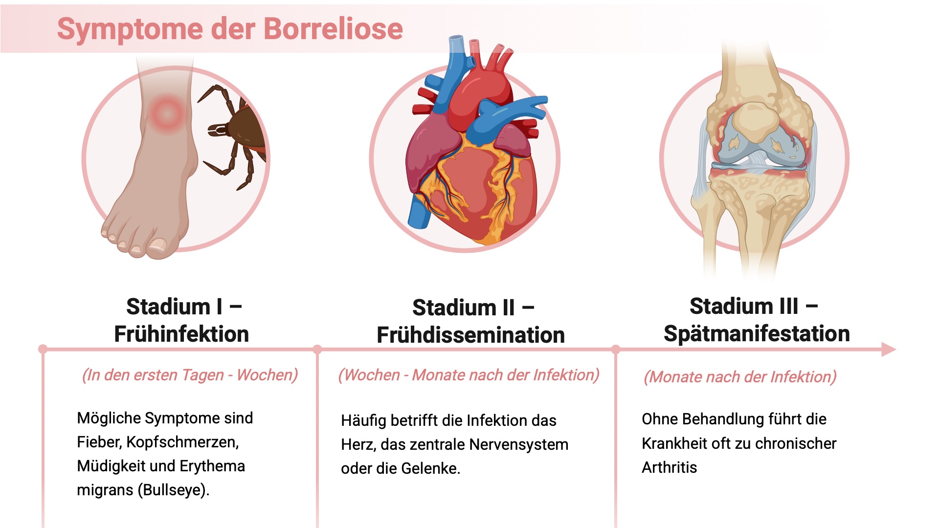 Phasen der Borreliose