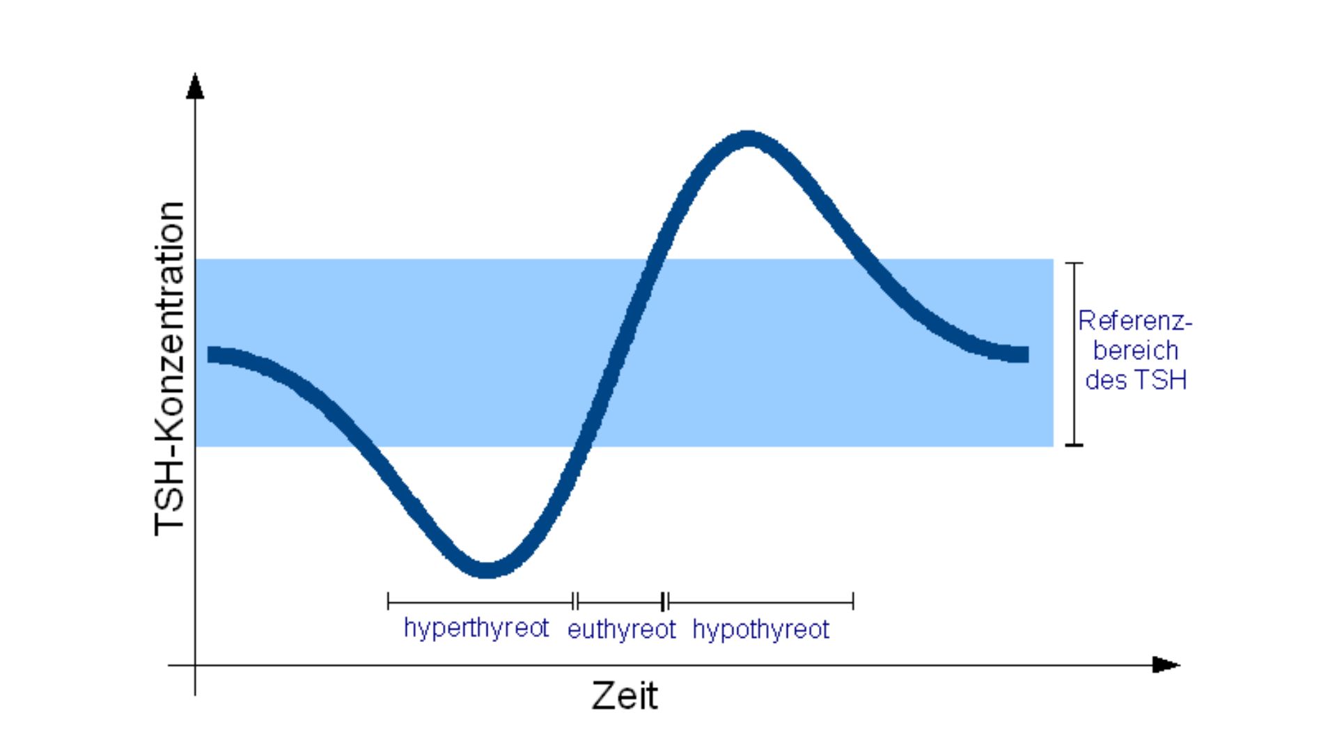TSH-Konzentration bei der subakuten Thyreoiditis de Quervain
