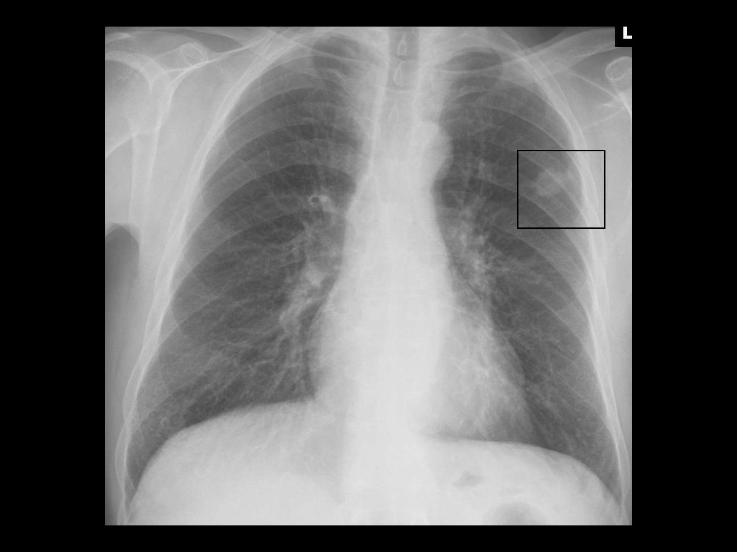 Tumorverdächtig im Röntgen-Thorax: Rundherd
