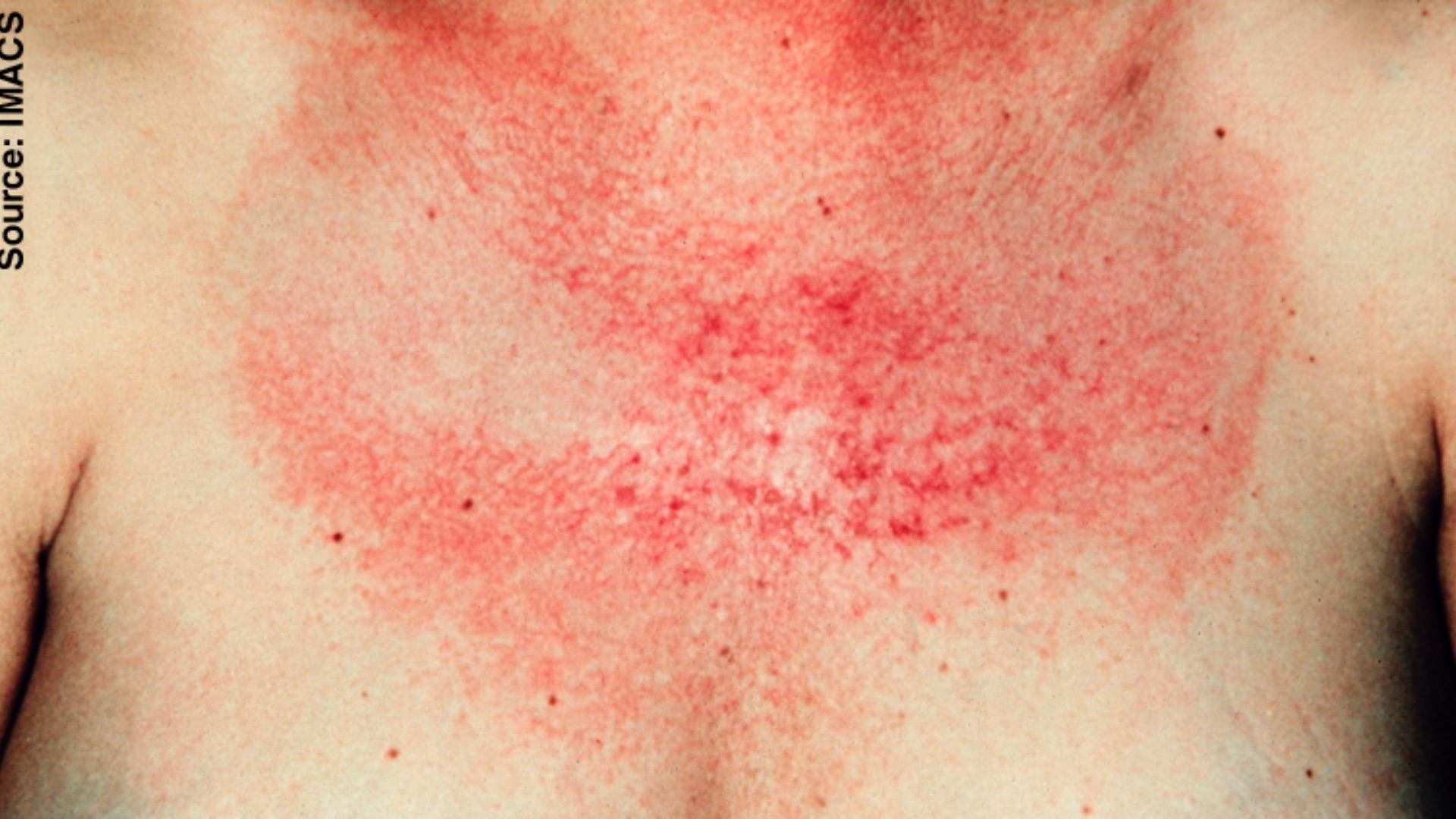 Erythem mit Teleangiektasien