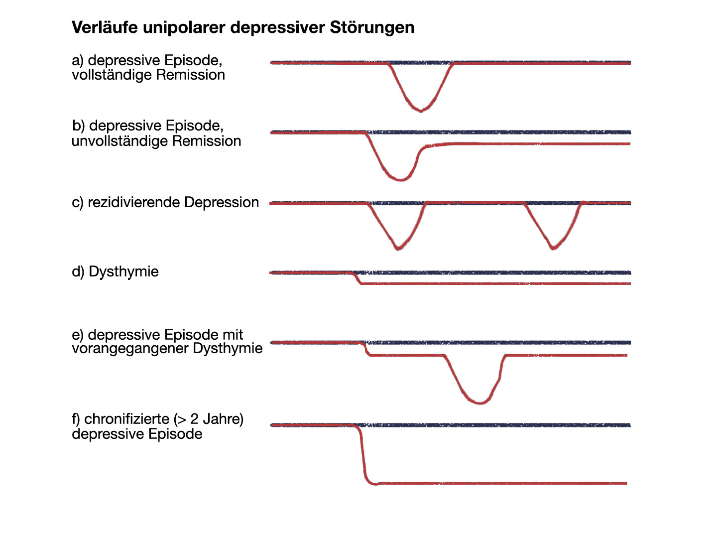 Verläufe unipolarer depressiver Störungen