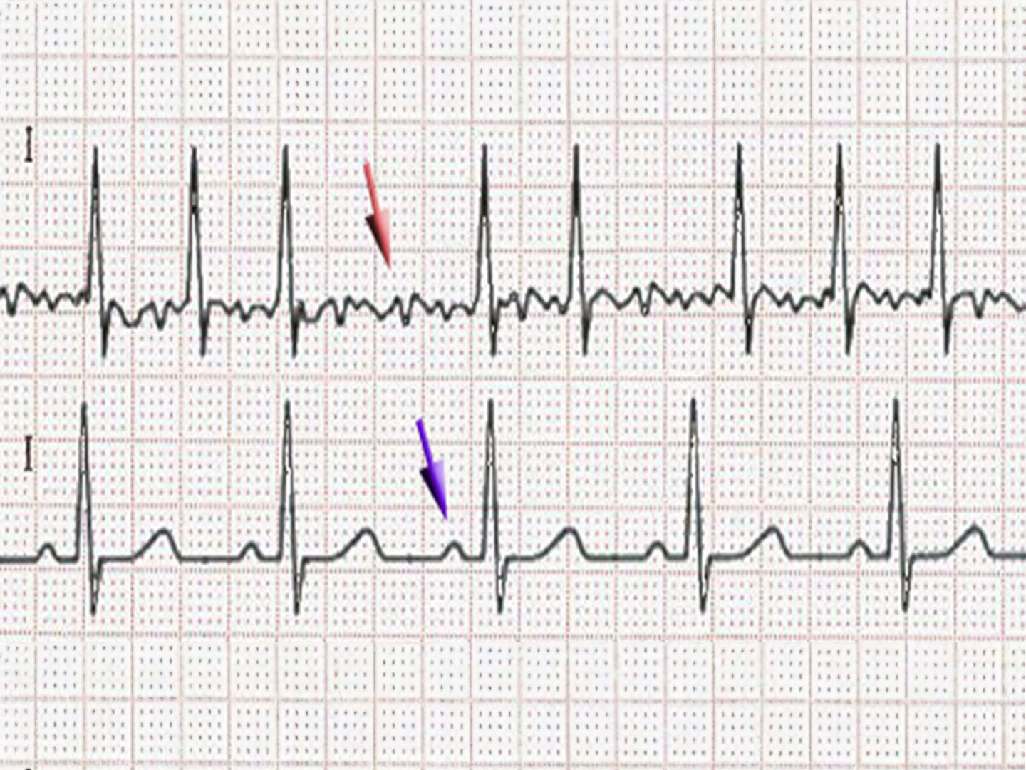 Vorhofflimmern im EKG