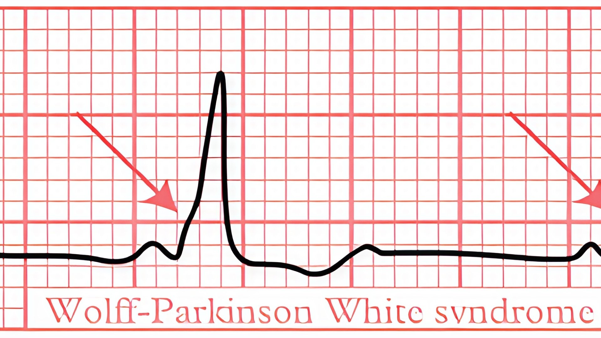 Wolff-Parkinson-White-Syndrom (WPW)
