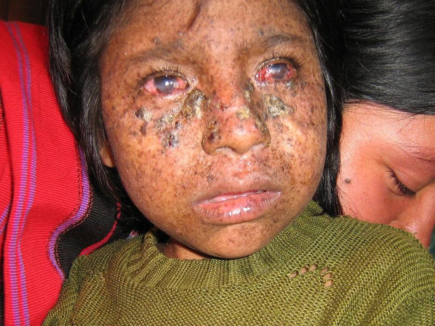 Xeroderma pigmentosum