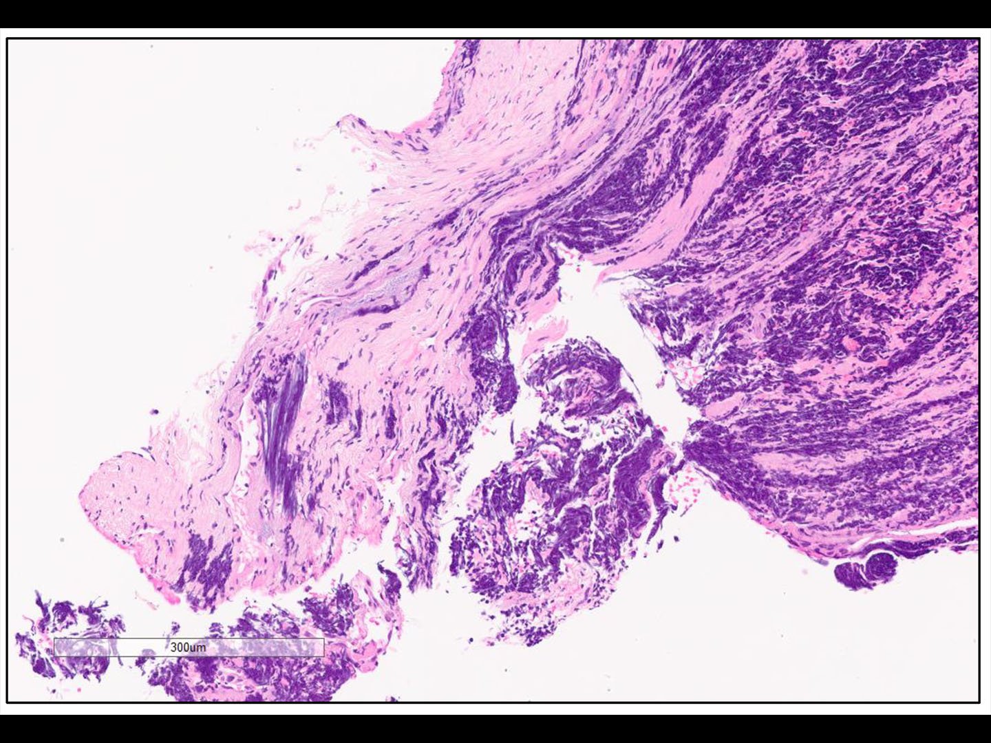 Nuclear chromatin smearing