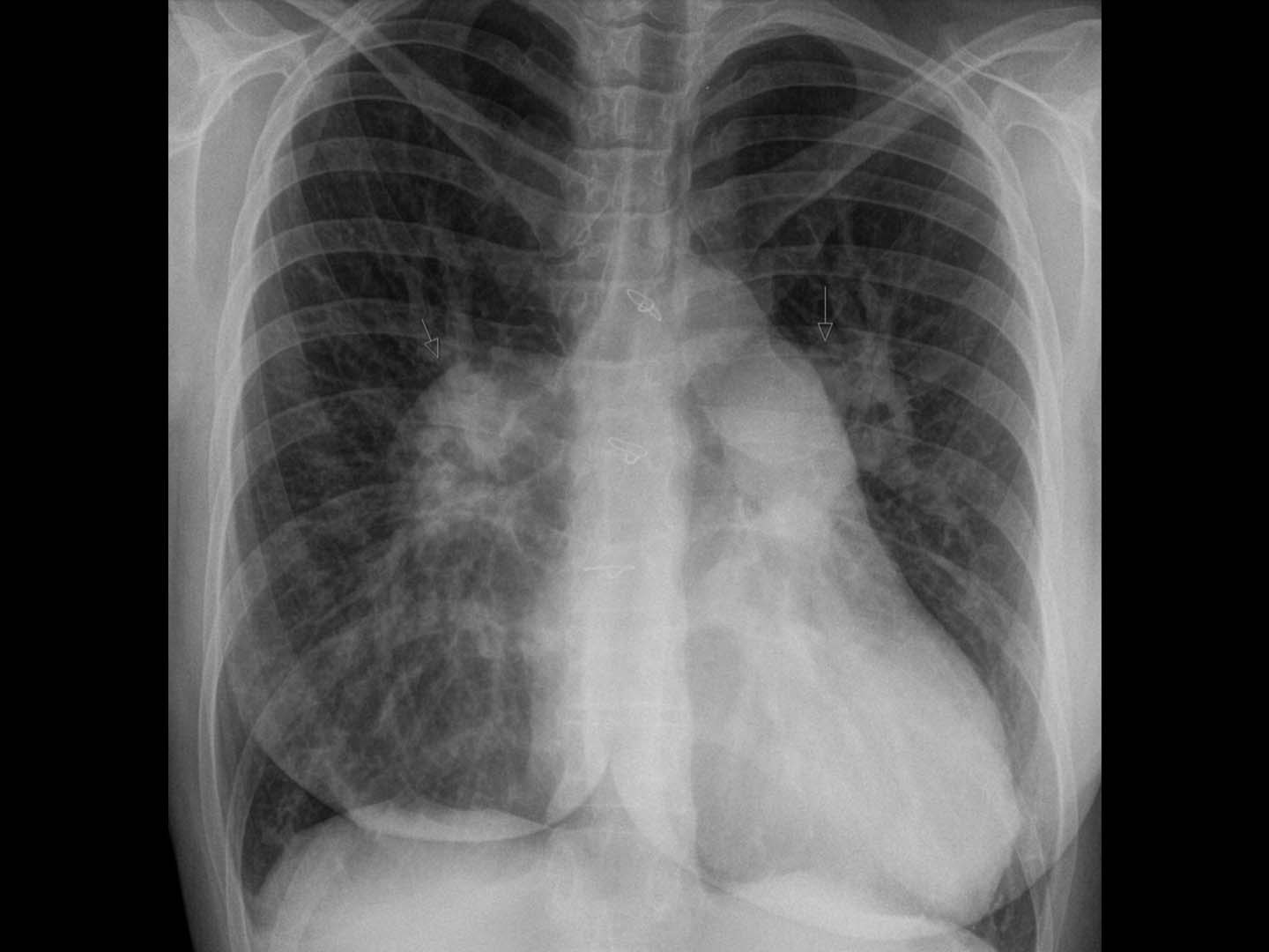 Röntgen-Thorax: Schwere pulmonale Hypertonie