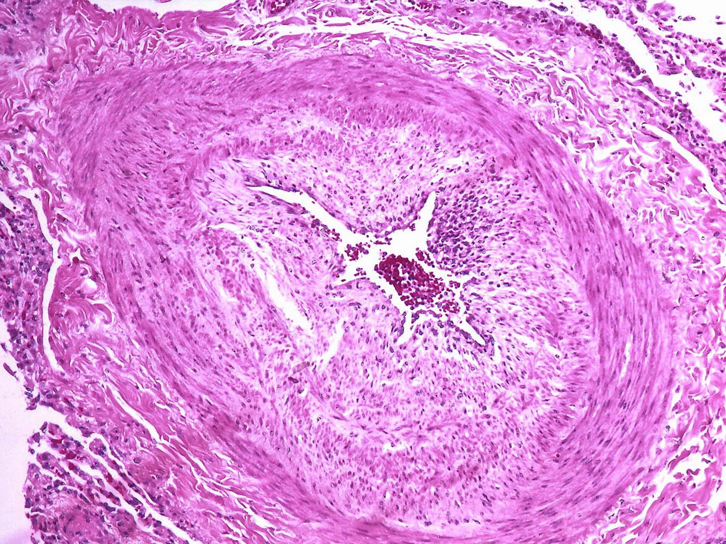 Vaskulopathie bei Pulmonal Arterieller Hypertonie