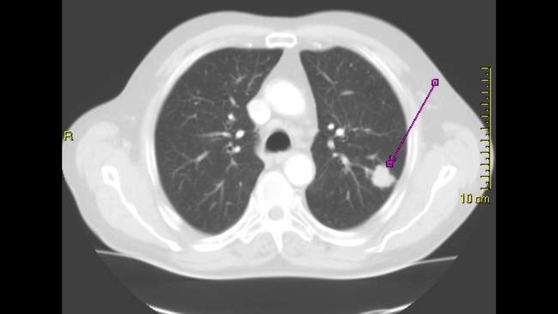 CT Bronchialkarzinom
